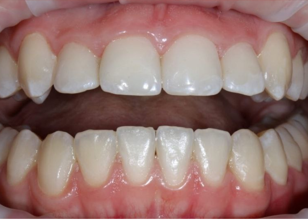 Имплантация зубов