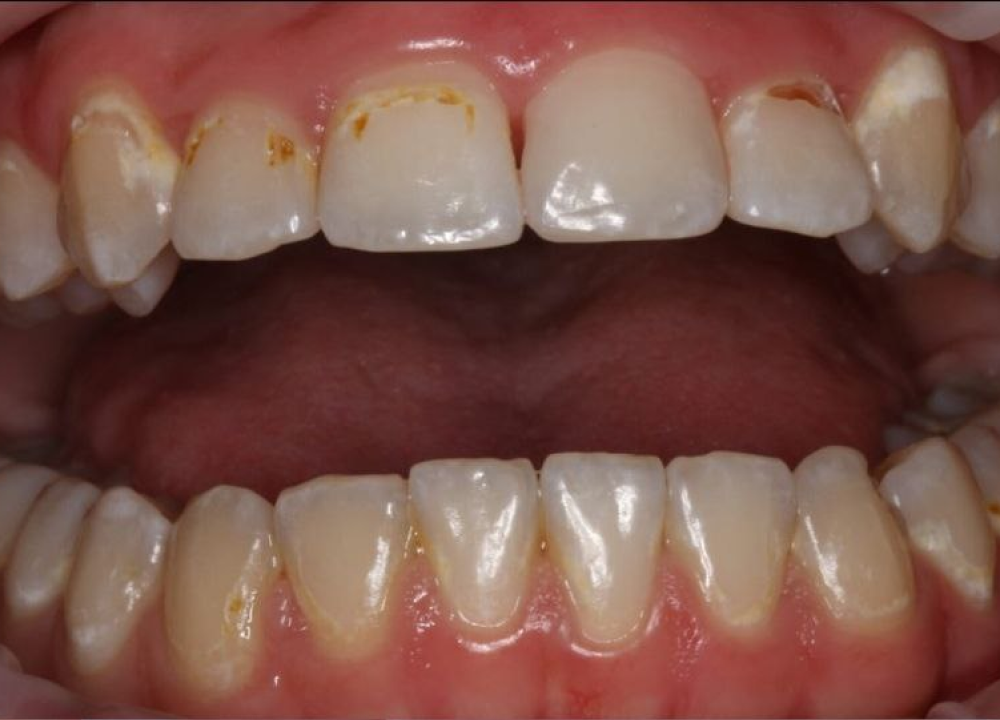 Профессиональная гигиена до лечения