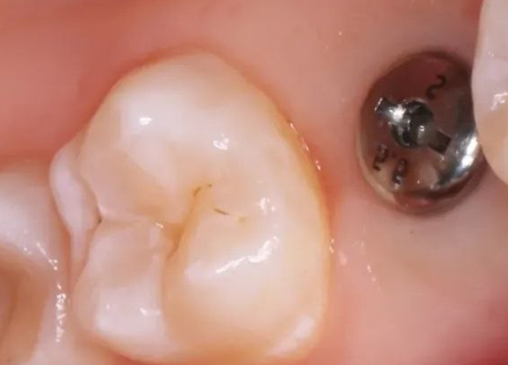 Отбеливание до лечения