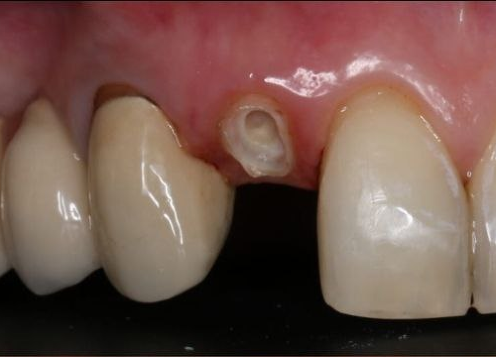 Эстетическая реставрация до лечения